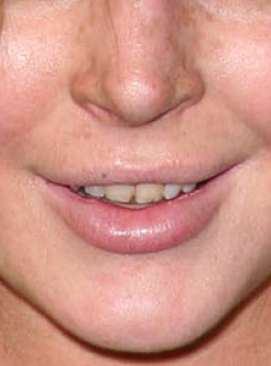 Lindsay Lohan Teeth